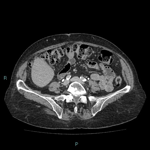 File:Adrenal collision tumor (ACT) (Radiopaedia 48462-53379 Axial C+ delayed 43).jpg