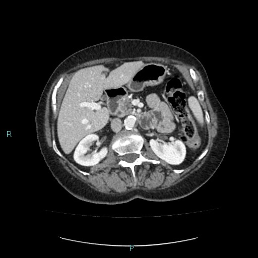 File:Adrenal collision tumor (ACT) (Radiopaedia 48462-53379 Axial C+ portal venous phase 21).jpg