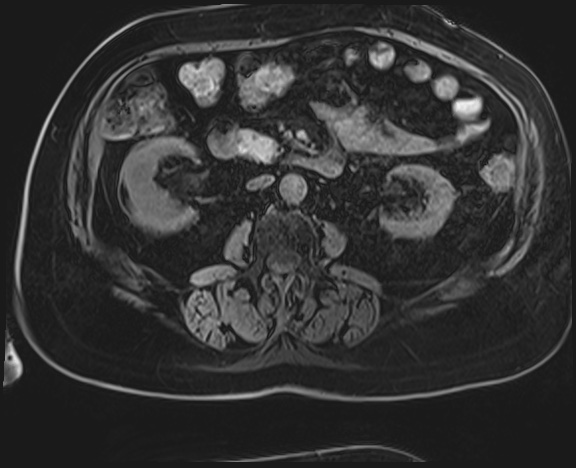 Adrenal cortical carcinoma (Radiopaedia 64017-72770 Axial T1 C+ fat sat 30).jpg
