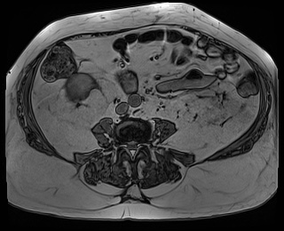 File:Adrenal cortical carcinoma (Radiopaedia 64017-72770 Axial T1 out-of-phase 61).jpg