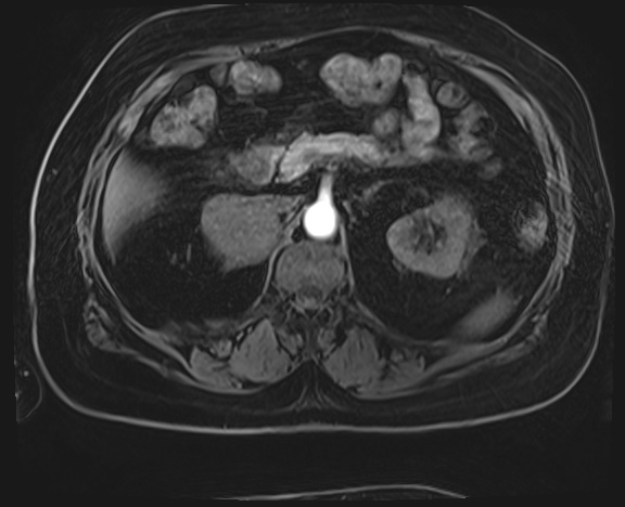 Adrenal cortical carcinoma (Radiopaedia 64017-72770 H 15).jpg