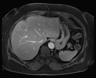Adrenal cortical carcinoma (Radiopaedia 64017-72770 J 13).jpg