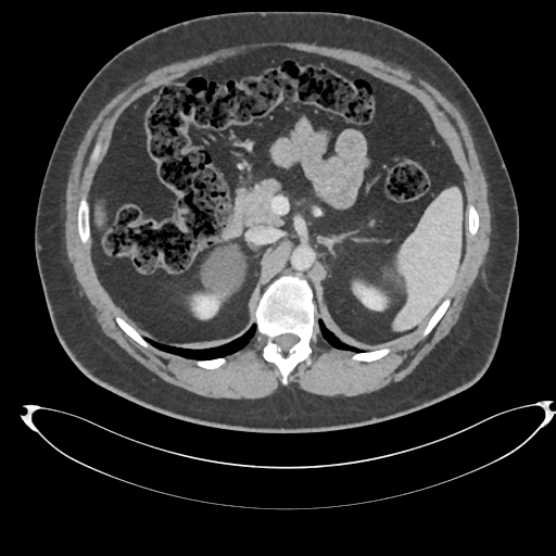 File:Adrenal cyst (Radiopaedia 45625-49778 AXIAL THICK 60 sec 25).png