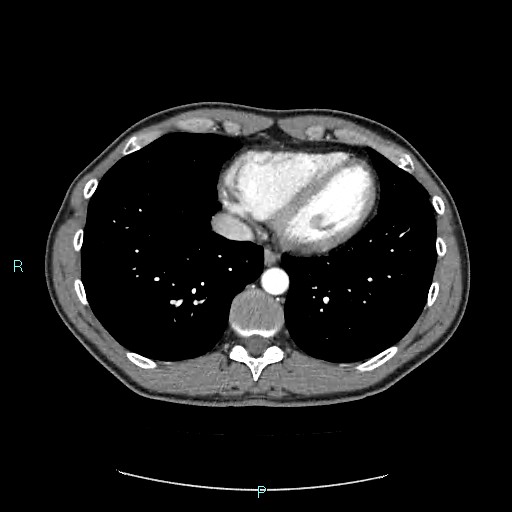 Adrenal cystic lymphangioma (Radiopaedia 83161-97534 Axial C+ arterial phase 7).jpg