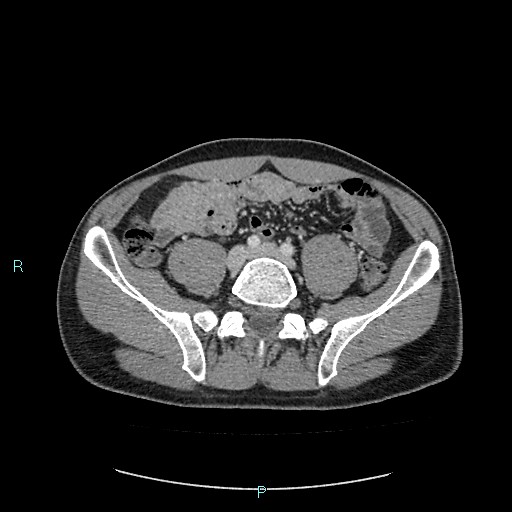 Adrenal cystic lymphangioma (Radiopaedia 83161-97534 Axial C+ portal venous phase 67).jpg