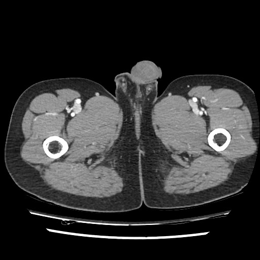 File:Adrenal gland trauma (Radiopaedia 81351-95078 Axial Dual bolus trauma C+ 133).jpg