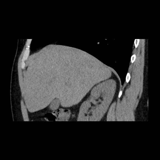 Adrenal gland trauma (Radiopaedia 81351-95079 Sagittal non-contrast 30).jpg