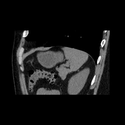 File:Adrenal gland trauma (Radiopaedia 81351-95079 Sagittal non-contrast 81).jpg
