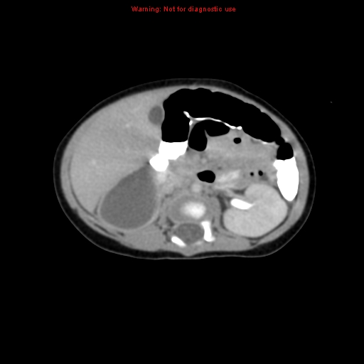 File:Adrenal hemorrhage (Radiopaedia 9390-10077 Axial C+ portal venous phase 12).jpg