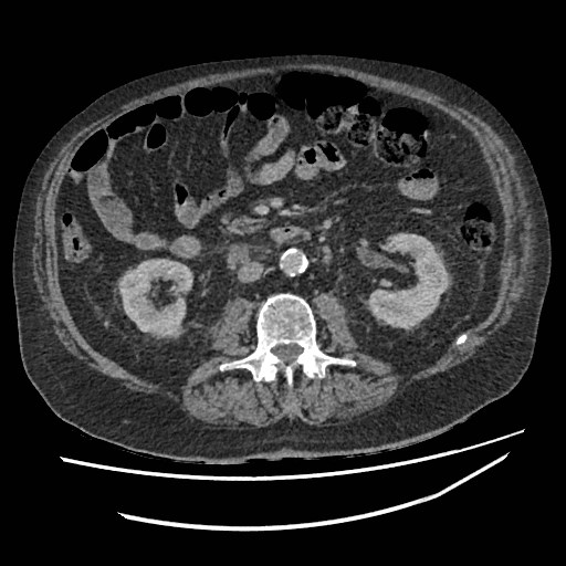 Adrenal lymphoma (Radiopaedia 84145-99415 Axial C+ portal venous phase 66).jpg