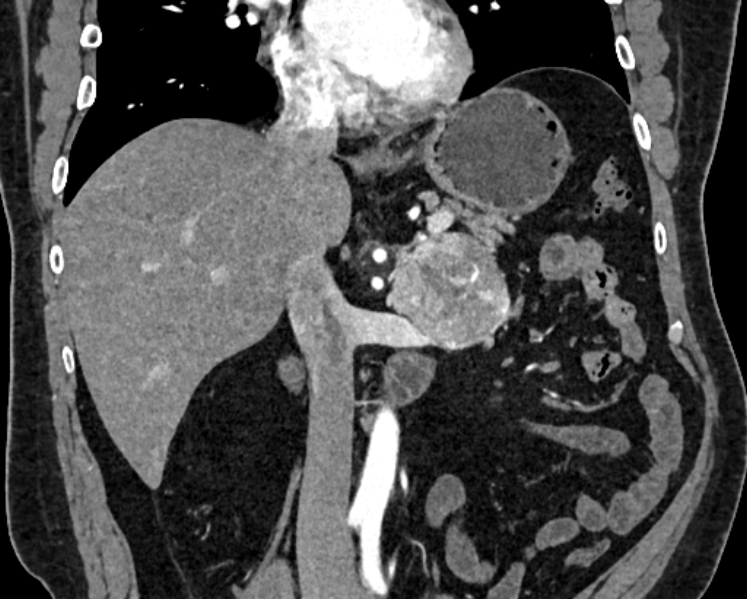Adrenal metastases (Radiopaedia 73082-83791 Coronal C+ arterial phase 17).jpg