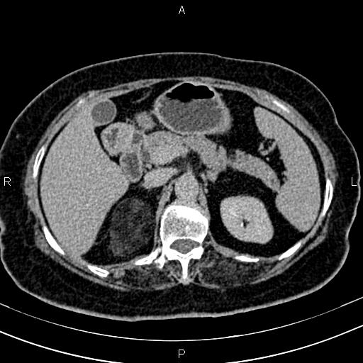 Adrenal myelolipoma (Radiopaedia 82742-96986 Axial renal excretory phase 43).jpg