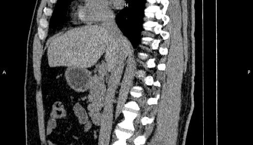 Adrenal myelolipoma (Radiopaedia 84321-99619 Sagittal non-contrast 48).jpg