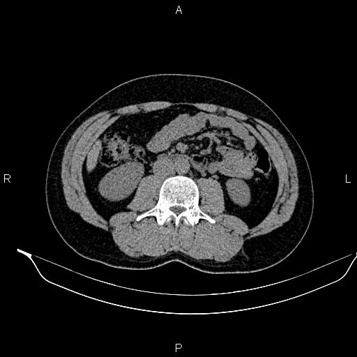 File:Adrenal myelolipoma (Radiopaedia 87794-104246 Axial non-contrast 55).jpg