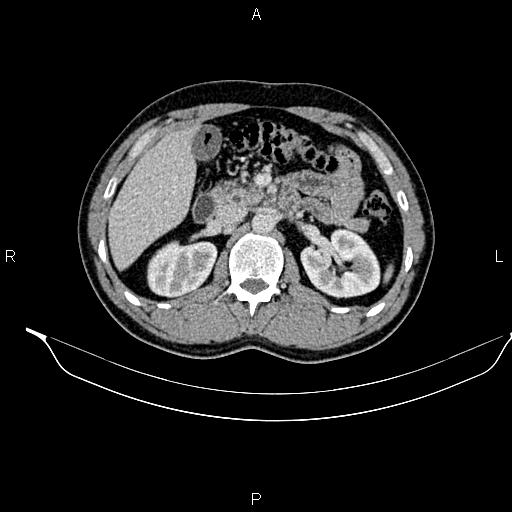 Adrenal myelolipoma (Radiopaedia 87794-104246 Axial renal cortical phase 40).jpg