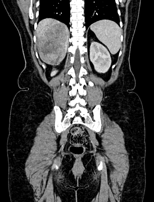 Adrenocortical carcinoma (Radiopaedia 87281-103569 Coronal C+ portal venous phase 110).jpg