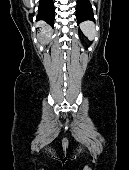 Adrenocortical carcinoma (Radiopaedia 87281-103569 Coronal C+ portal venous phase 134).jpg