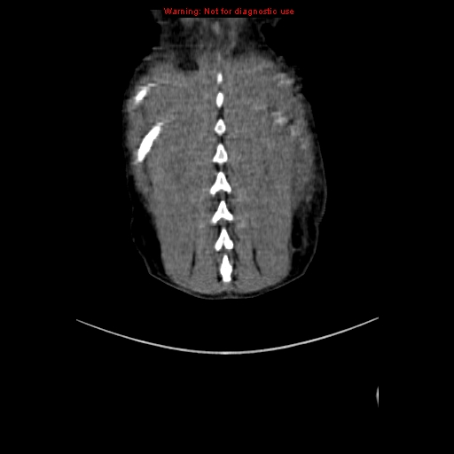 File:Adrenocortical carcinoma (Radiopaedia 9449-10131 Coronal C+ portal venous phase 21).jpg
