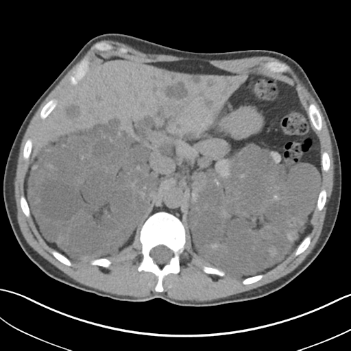 Adult polycystic kidney disease (Radiopaedia 47866-52626 Axial non-contrast 22).png
