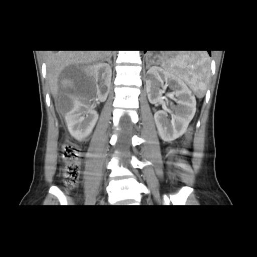 File:Adult polycystic kidney disease (Radiopaedia 48845-53876 Coronal renal cortical phase 25).jpg