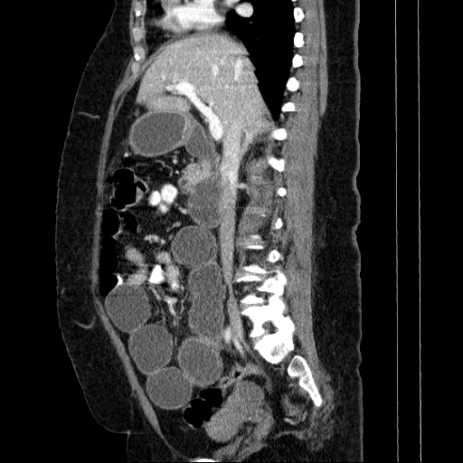 Afferent loop syndrome - secondary to incarcerated trocar site hernia (Radiopaedia 82959-97305 Sagittal C+ portal venous phase 91).jpg