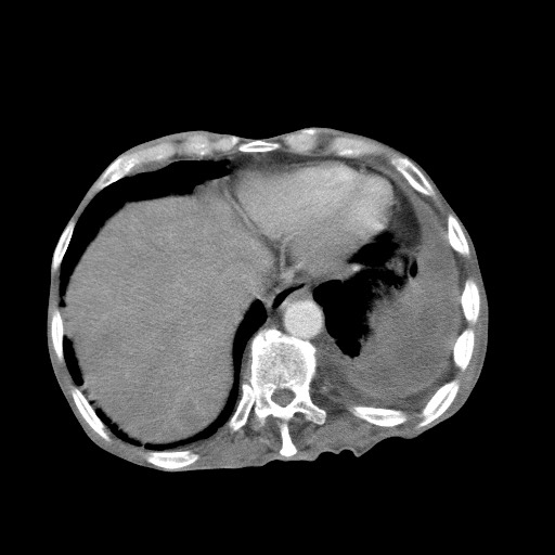 File:Aggressive lung cancer with cardiac metastases, pulmonary artery tumor thrombus, and Budd-Chiari (Radiopaedia 60320-67981 A 46).jpg