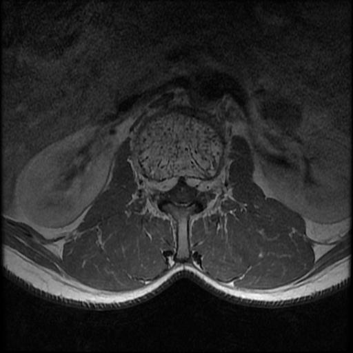 File:Aggressive vertebral hemangioma with pathological fracture (Radiopaedia 69528-79411 Axial T1 C+ 11).jpg