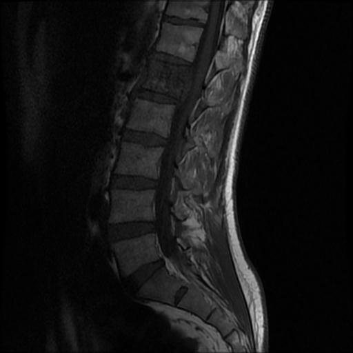 File:Aggressive vertebral hemangioma with pathological fracture (Radiopaedia 69528-79411 Sagittal T1 6).jpg