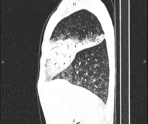 File:Air bronchogram in pneumonia (Radiopaedia 85719-101512 Sagittal lung window 27).jpg