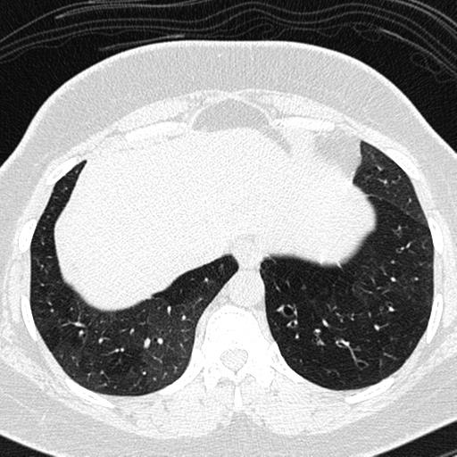 File:Air trapping in small airway disease (Radiopaedia 61685-69694 Axial lung window 155).jpg