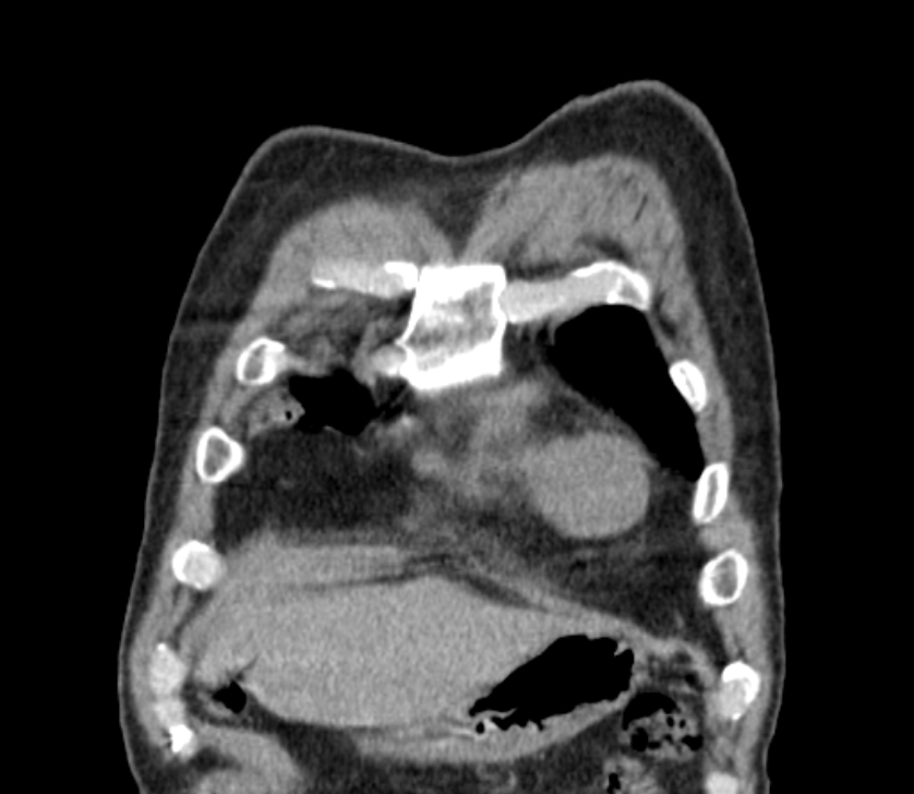 Airway foreign body in adult (Radiopaedia 85907-101779 Coronal liver window 22).jpg