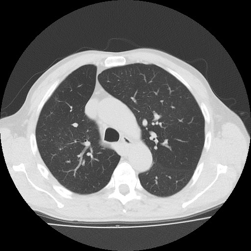 Allergic bronchopulmonary aspergillosis (ABPA) (Radiopaedia 60594-68313 Axial lung window 19).jpg