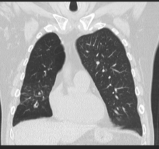 Allergic bronchopulmonary aspergillosis (Radiopaedia 44760-48571 Coronal lung window 21).png