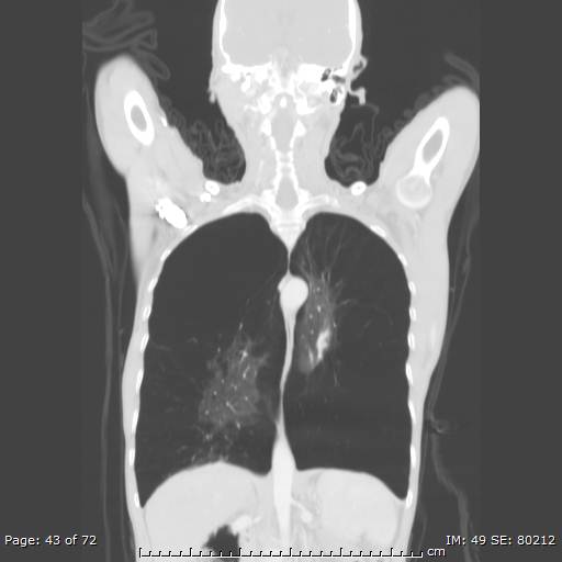 Alpha-1-antitrypsin deficiency (Radiopaedia 50561-55987 Coronal lung window 41).jpg