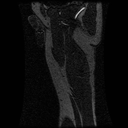 Alveolar soft part sarcoma (Radiopaedia 64501-73678 D 28).jpg