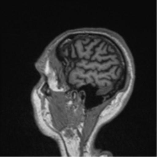 Alzheimer's disease- with Gerstmann syndrome and dressing apraxia (Radiopaedia 54882-61150 Sagittal T1 7).png