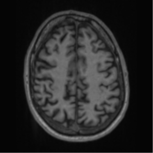 Alzheimer's disease- with apraxia (Radiopaedia 54763-61011 Axial T1 54).png