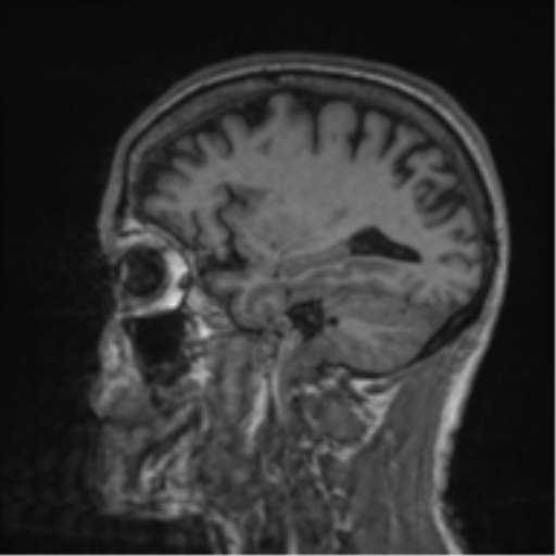 Alzheimer's disease- with apraxia (Radiopaedia 54763-61011 Sagittal T1 21).png