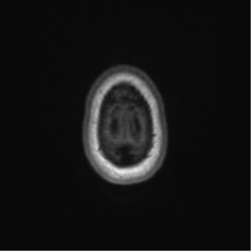 File:Alzheimer's disease (Radiopaedia 42658-45802 Axial T1 13).png