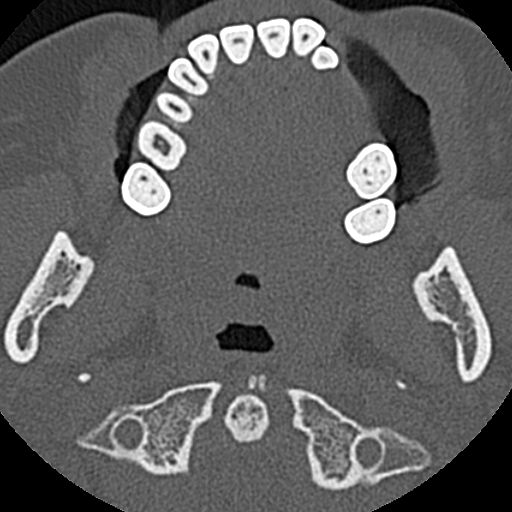 Ameloblastic fibro-odontoma (Radiopaedia 18843-18780 C 51).jpg