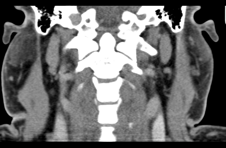 Ameloblastoma (Radiopaedia 33677-34806 Coronal non-contrast 47).png