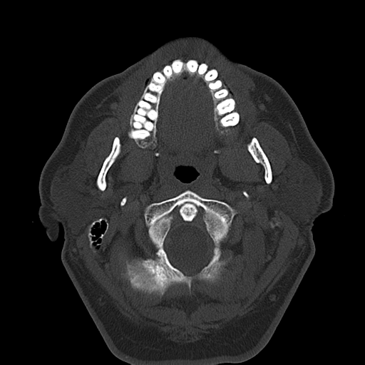 Ameloblastoma (Radiopaedia 38520-40623 Axial bone window 23).png