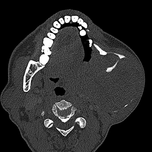Ameloblastoma (Radiopaedia 51921-57766 Axial bone window 78).jpg