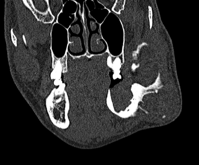Ameloblastoma (Radiopaedia 51921-57766 Coronal bone window 95).jpg