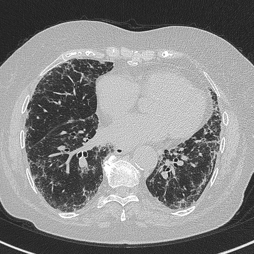 Amiodarone-induced pulmonary fibrosis (Radiopaedia 82355-96460 Axial lung window 45).jpg