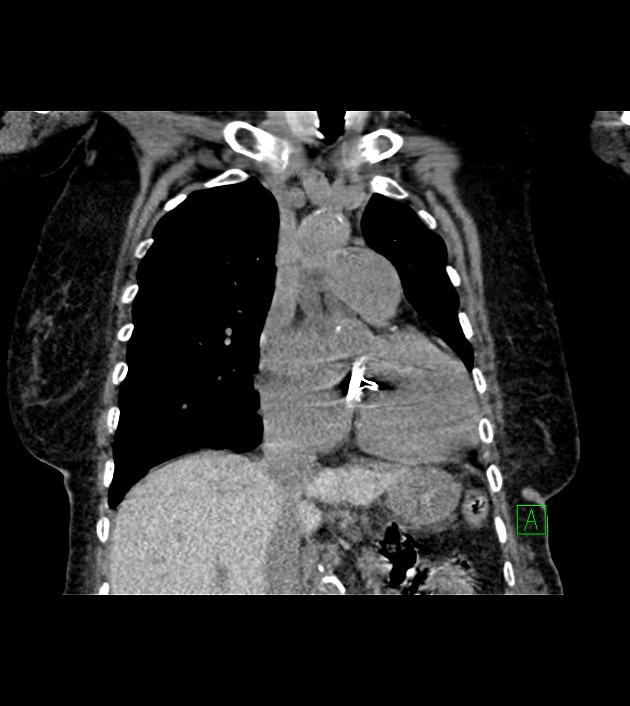 Amiodarone deposition in the liver (Radiopaedia 77587-89780 Coronal non-contrast 33).jpg