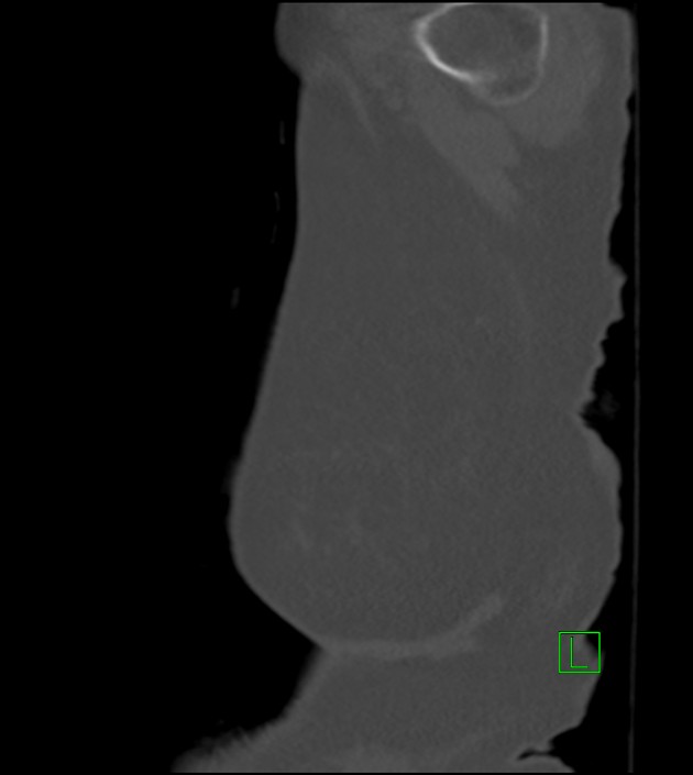 Amiodarone deposition in the liver (Radiopaedia 77587-89780 Sagittal bone window 4).jpg