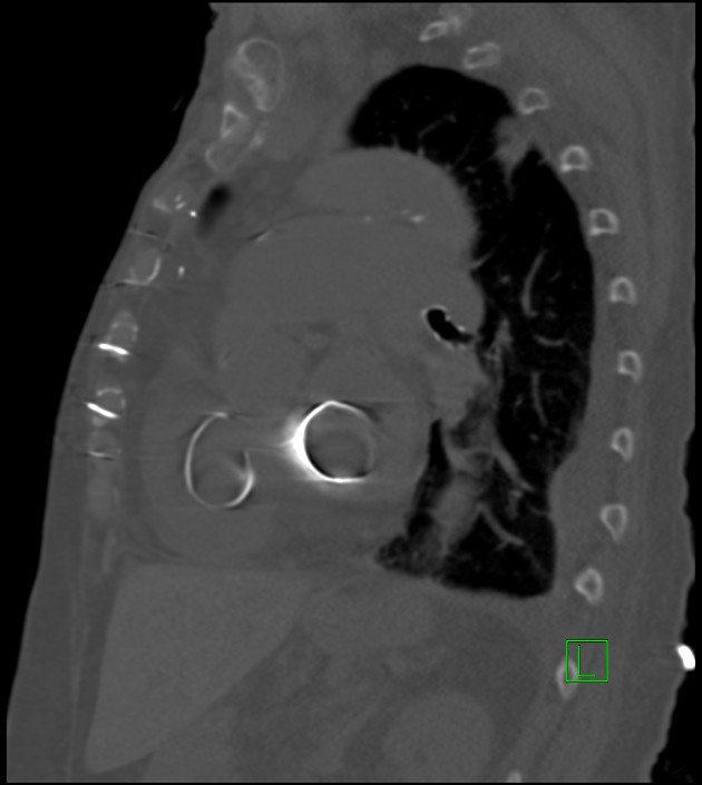 Amiodarone deposition in the liver (Radiopaedia 77587-89780 Sagittal bone window 41).jpg