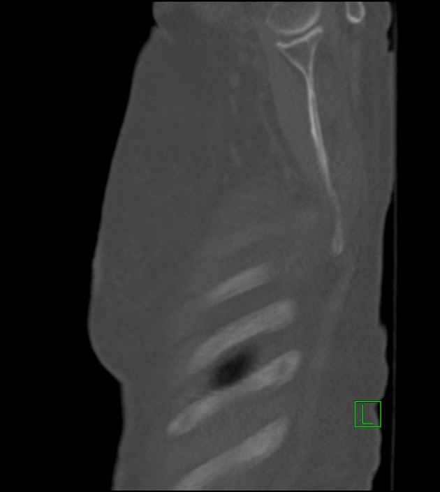 Amiodarone deposition in the liver (Radiopaedia 77587-89780 Sagittal bone window 88).jpg