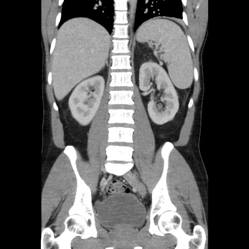 Amoebic liver abscesses (Radiopaedia 55536-62009 B 34).jpg